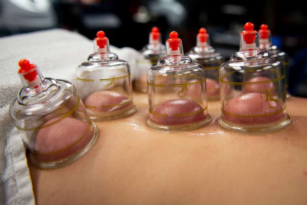 Hijama cups placed on a person's back during a session